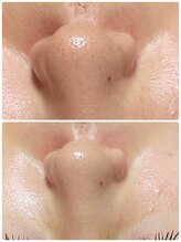 トータルビューティーサロン ヴィヴィエ(ViVier)/ハイドロフェイシャル症例1回