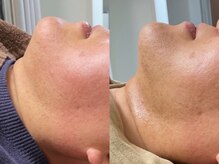 ピュアリー(purly)/【レモンボトル】Before After