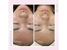 シャルムパリス(charme paris)/大人ニキビケア☆１回の施術変化