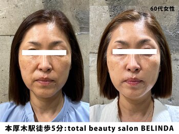 ベリンダ(BELINDA)/セルマンピーリング