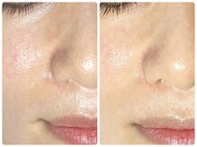 ラウン 京都(ROUN')/エンビロン・1回施術