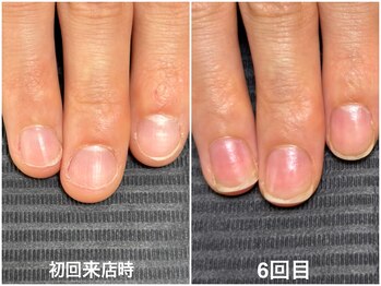 【自爪育成】1ヶ月半での変化