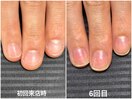 【自爪育成】1ヶ月半での変化