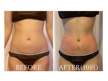 モテスリム/脂肪冷却 お腹2カップ