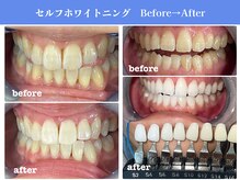 エクシアホワイトニング 岡崎店/歯の黄ばみ撃退★白さ満足度No.1