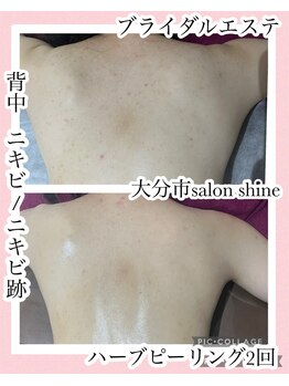 サロンシャイン(Salon Shine)/背中ハード2回