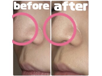 ローマサロン/毛穴洗浄とトリートメント