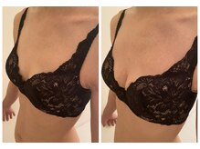 ソラ(sora)/1度の施術で谷間出現★