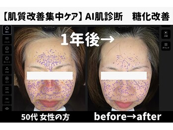 サロンスペース/50代女性 AI肌診断 1年後