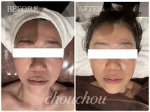 シュシュ(chouchou)/小顔美肌フルコース