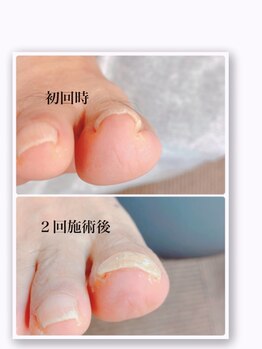 一宮巻き爪センター/巻き爪