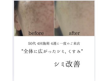 シミリセット 名駅(シミReset)/広がるシミ・改善