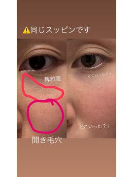 リノン(LIINON)/スキンケアだけで?!