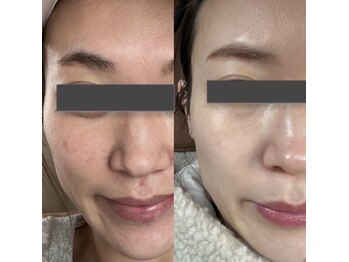 サナン(SANAN)/NMN白玉ピールの効果