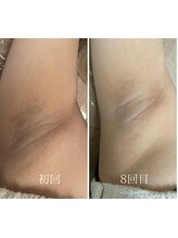 ケリー(KELLY)/脱毛/わき脱毛