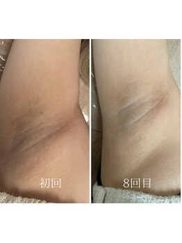 ケリー(KELLY)/脱毛/わき脱毛