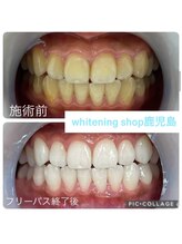 ホワイトニングショップ 鹿児島店/#鹿児島ホワイトニング