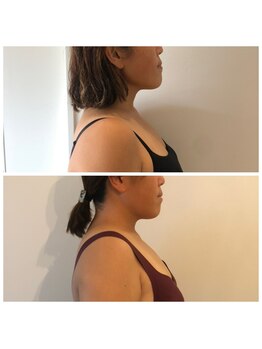 ミチカケ トリムリターン那覇市店/横顔の印象が変わる！