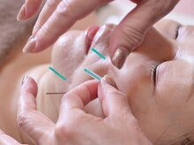 初めての美容鍼もお任せください◎小顔/リフトアップ/たるみ予防