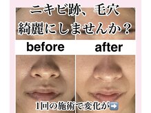 ホリシア 博多(HORISHIA)/ハーブピーリング/ニキビケア