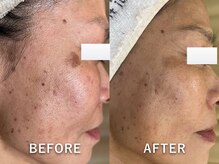 エヴェリーナ(Eveliiina)/50代女性シミケア/フェイシャル