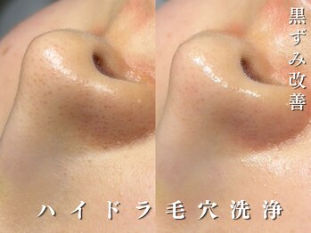 ダリア(Dahlia)/ララピール+毛穴洗浄