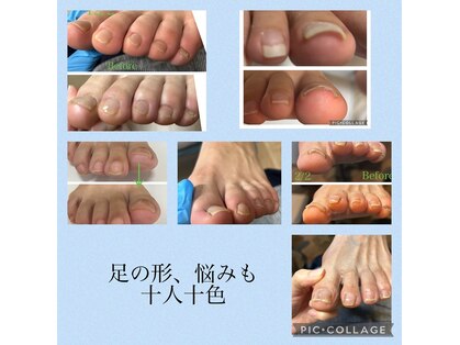 フッティーナNs＋【巻き爪/フットケア/魚の目/タコ/足裏ケア】【8月中旬OPEN(予定)】の写真