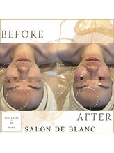 サロン ド ブラン アオヤマ(Salon de BLANC AOYAMA)/BLANC式小顔/水艶肌