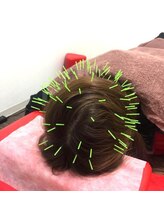 よつば鍼灸整骨院 春日院/頭皮鍼