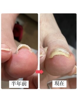 シャンス(chance)/痛みから解消！巻き爪ケア