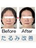【頬のたるみ・ほうれい線に】1回で実感☆ たるみ改善コース