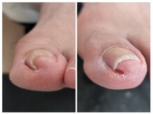 フレッシュフット(FreshFoot)/足のトラブルお任せください