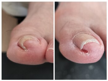 フレッシュフット(FreshFoot)/足のトラブルお任せください