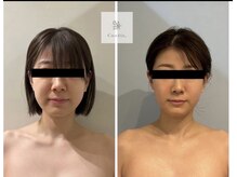 ミセルビューティー 御堂筋本町(micell beauty)/脂肪分解