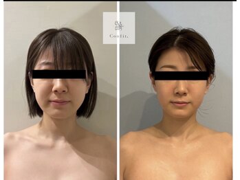 ミセルビューティー 御堂筋本町(micell beauty)/脂肪分解