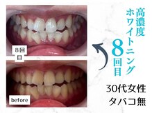 ルカノン(le canon)/自信が持てる口元になりました♪