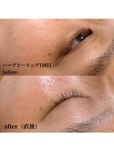 マティダ(Mathida)/【Revi】ハーブピーリング1回目