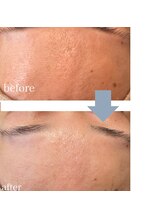 レベンディス(LEVENDIS)/ハーブピーリング