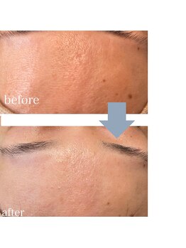 レベンディス(LEVENDIS)/ハーブピーリング