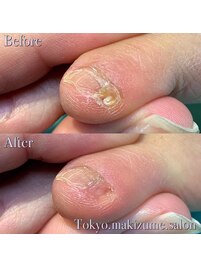 【巻き爪/魚の目/副爪/タコ】