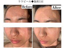 フレイヤ(FREYA)/ララピールBefore→After