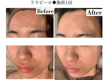 フレイヤ(FREYA)/ララピールBefore→After