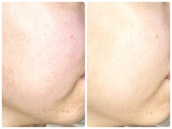 ラウン 京都(ROUN')/エンビロン・1回施術