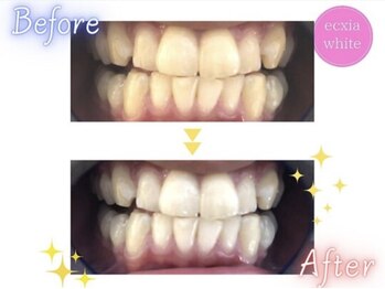 エクシアホワイトニング 静岡駅前店/ホワイトニングビフォーアフター