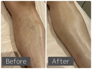 ミュリール 根津店(Murir)/光脱毛×wax脱毛　W脱毛も可能