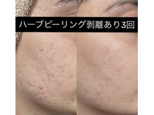 ソアン(Soin)/ハーブピーリング剥離あり
