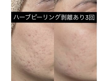 ソアン(Soin)/ハーブピーリング剥離あり