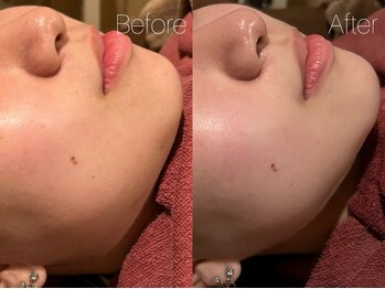 ビヨンド リンク(BEYOND L'INK)/フェイシャルマッサージ