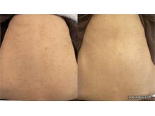 リラ(Lilas)/2回の変化