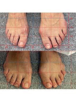 ハーモニーフィットネス 赤坂(Harmony Fitness)/足の親指変形改善
